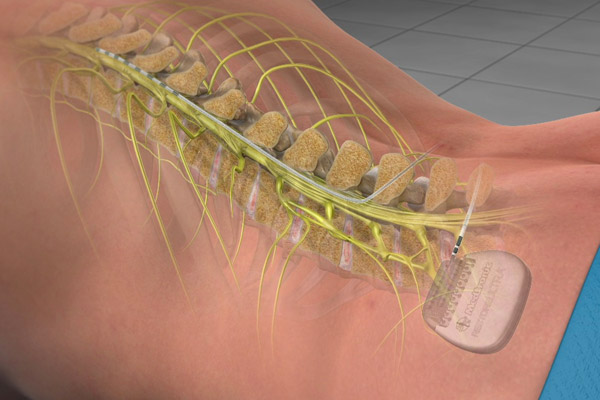 Spinal Cord Stimulator Device in Garden City