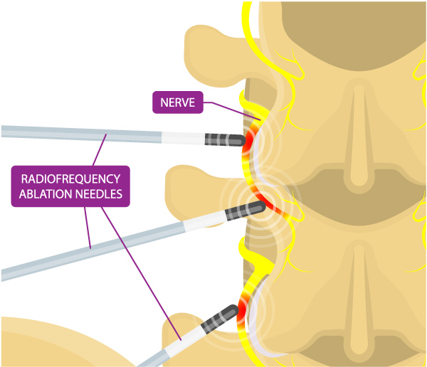 Radio Frequency Ablation for Pain in Garden City